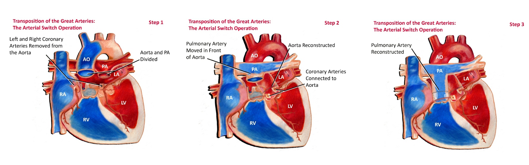 arterial switch operation
