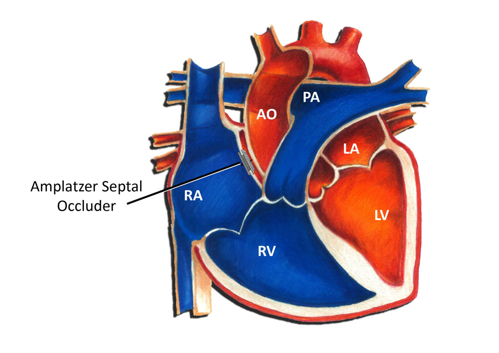 Atrial septal defect device closure