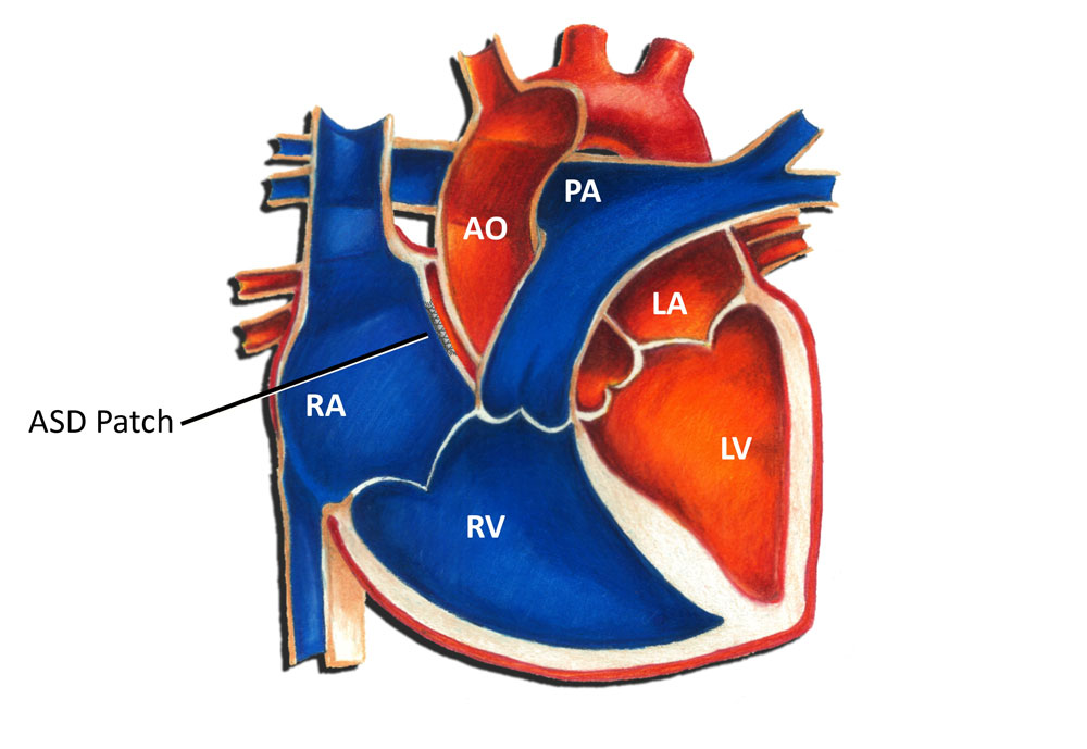 Atrial septal defect surgery