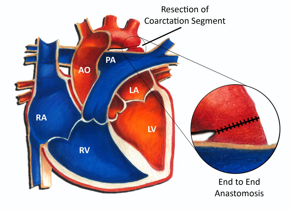 Coarctation of the aorta surgery