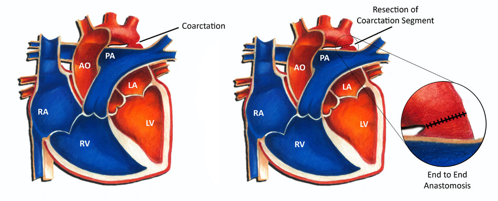 Coarctation of the Aorta - Surgery