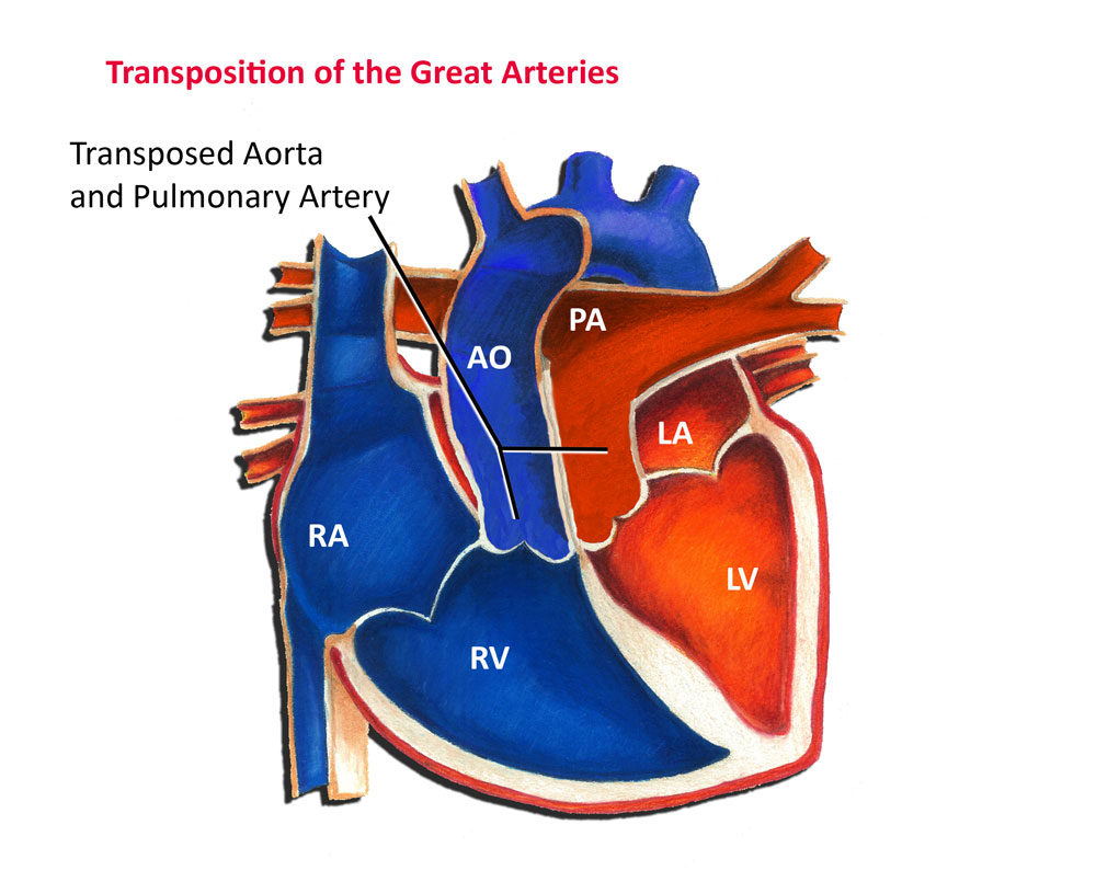 Transposition of the great arteries
