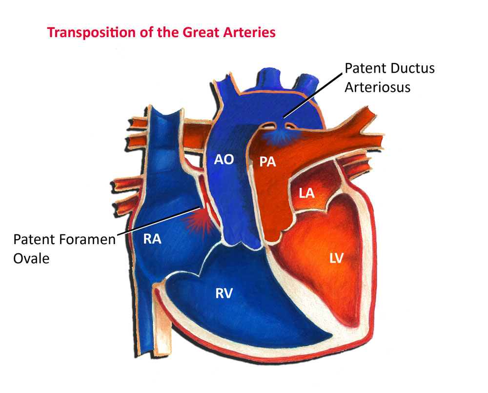 Transposition of the Great Arteries