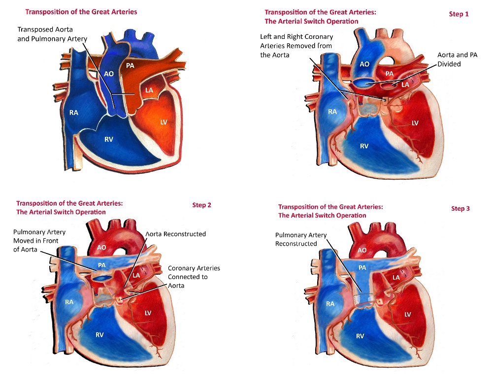 Transposition Of The Great Arteries - Pediatric Cardiology Associates ...