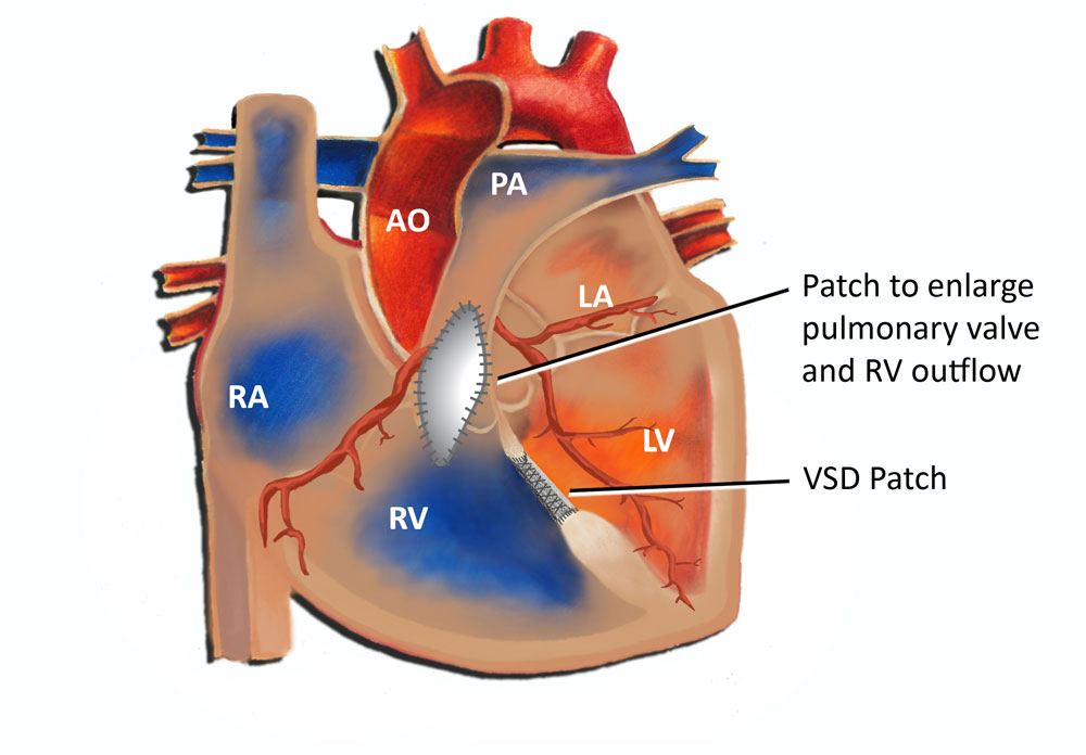 Tetralogy of Fallot surgery