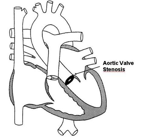 Aortic Valve Stenosis