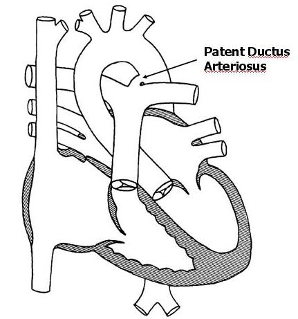 Patent Ductus Arteriosus