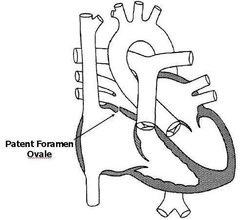 Patent Foramen Ovale