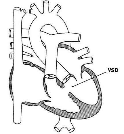 Ventricular Septal Defect